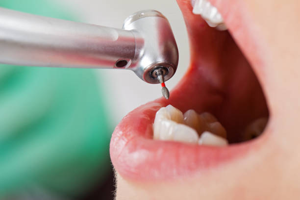 Best Emergency Tooth Extraction in Yamhill, OR